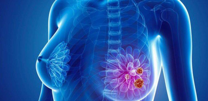 Breast cancer is a prevalent concern worldwide, and early detection is the cornerstone of effective treatment.